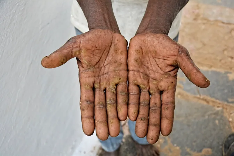 Hands and feet of former sarpanch Yuvraj Singh show signs of arsenical keratosis, 