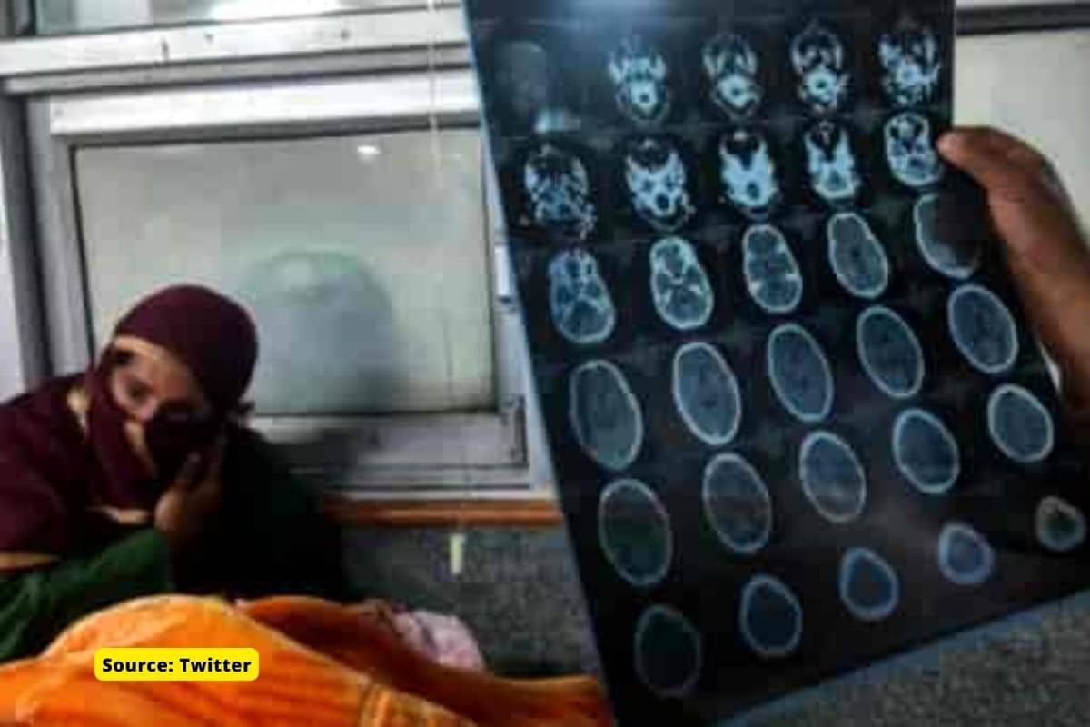 80% of pellet gun victims in Kashmir suffered some degree vision loss