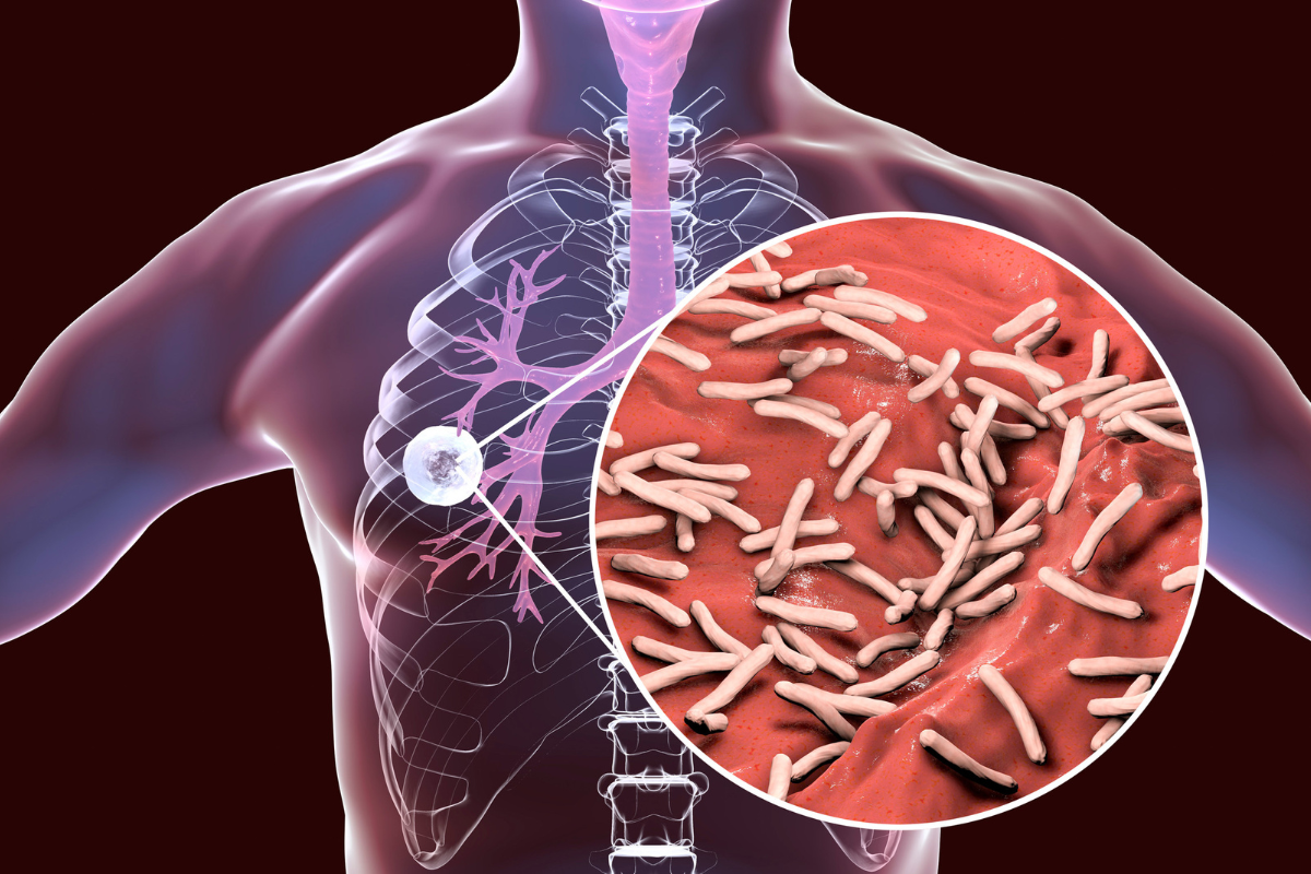 India Records 21.7 Lakh TB Cases: See Which State Tops the List