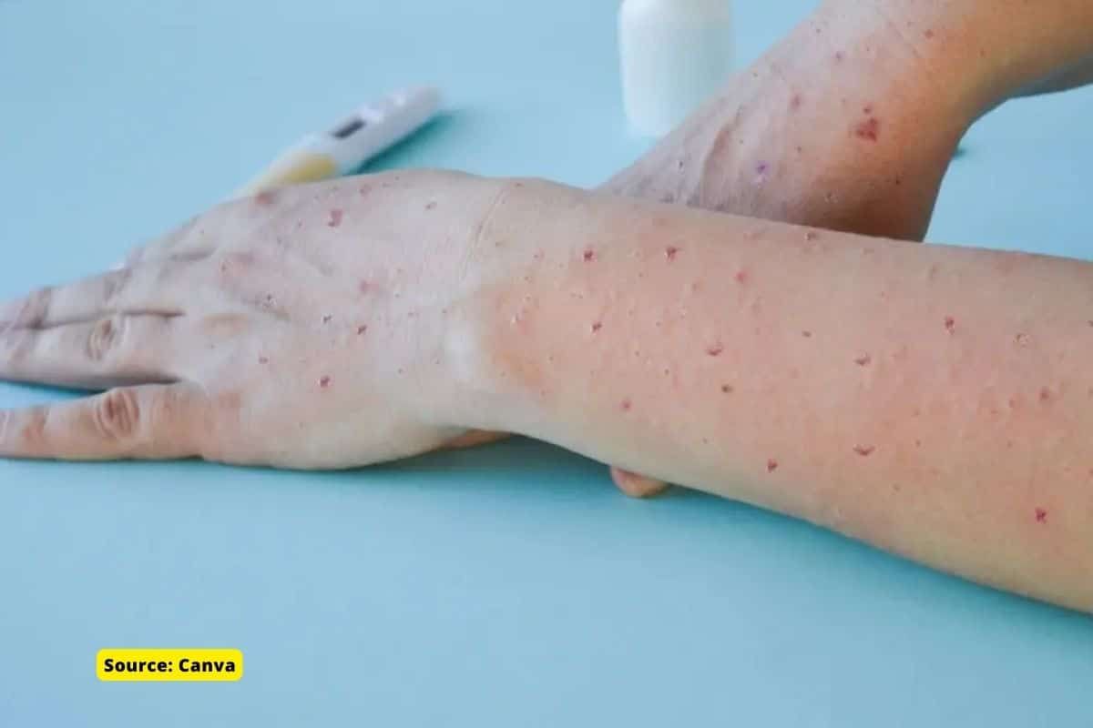 Explained: What is Tomato Flu? Causes, symptoms and treatment