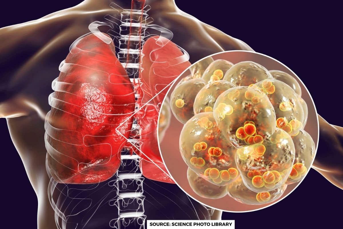 What is Pneumonia, Symptoms and risk factors