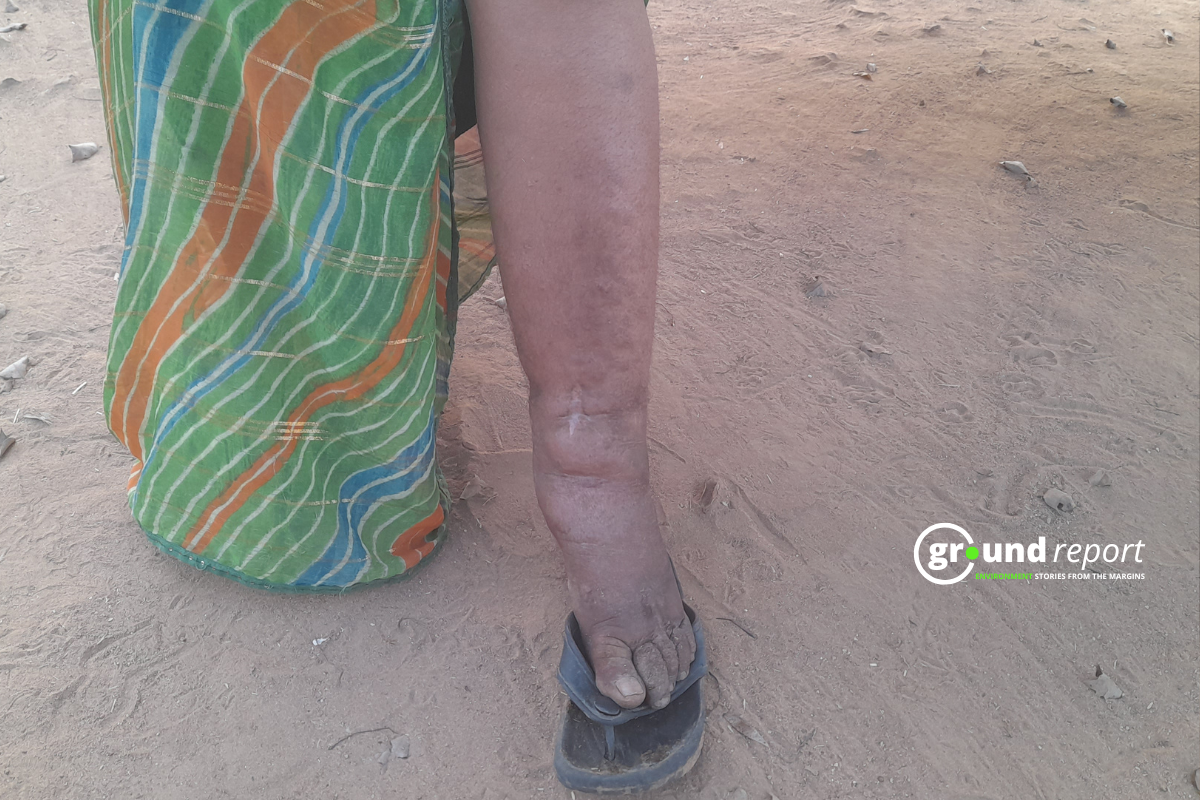 filariasis