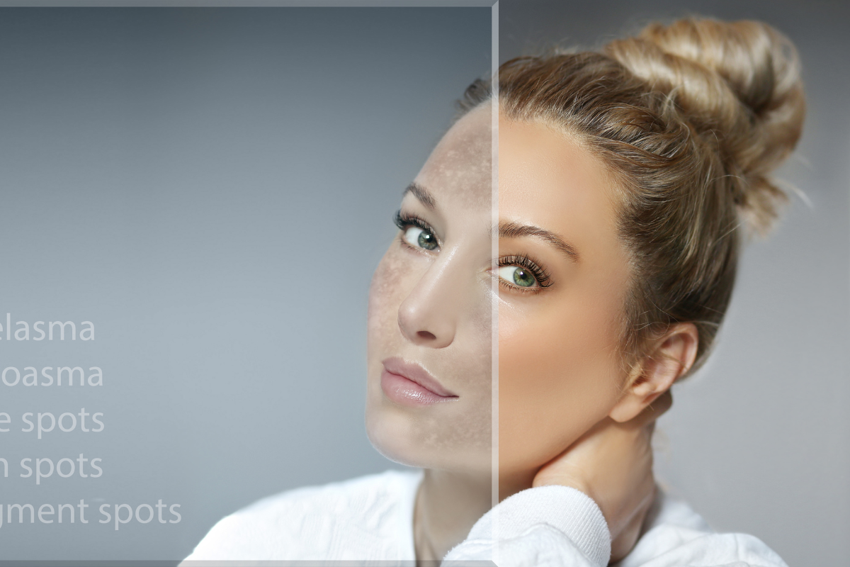 Glow Right with the Perfect Pigmentation Cream for Your Skin