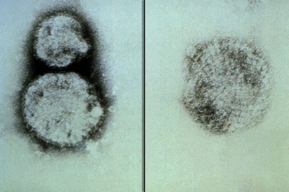 Hantavirus Explained: What It Is, How It Kills, and Why India Is at Risk